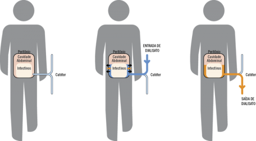 diálise-peritoneal.png